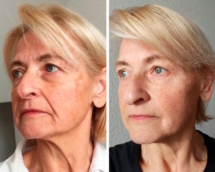 Side angle before and after skin comparison — individual results vary