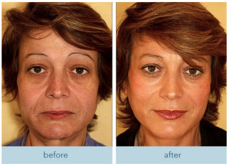 Before and after front-face skin comparison — customer submitted, results vary