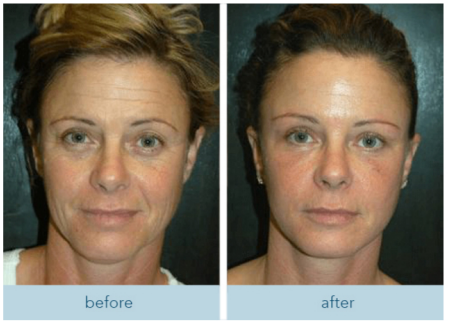 Before and after front-face skin comparison — customer submitted, results vary